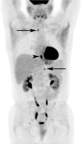 75 Esophageal Cancer Radiology Key