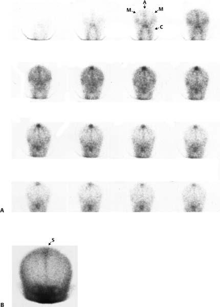 136 Normal Brain Flow study | Radiology Key