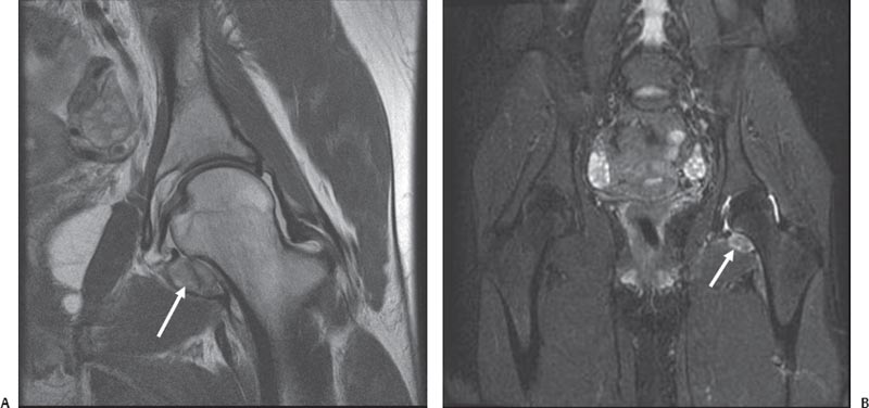 The Hip | Radiology Key