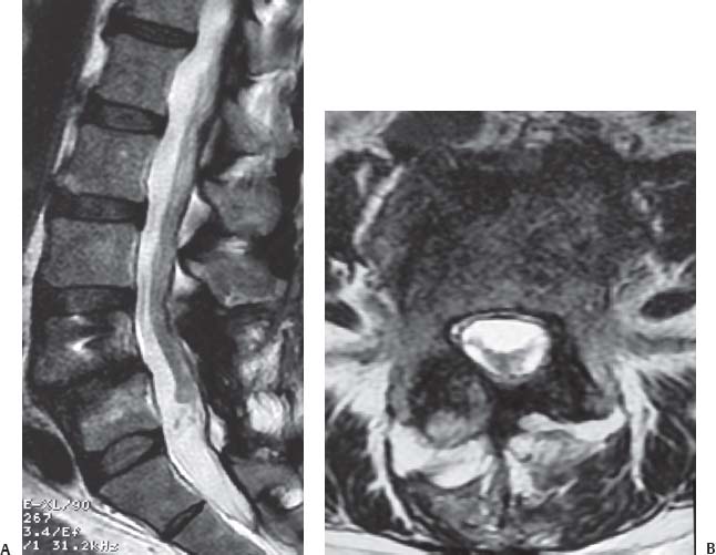 The Lumbar And Thoracic Spine Radiology Key