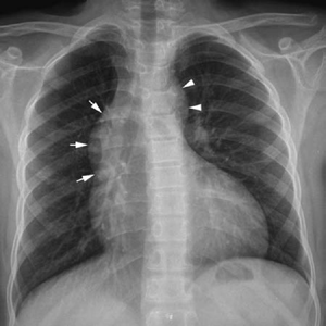 aortic stenosis x ray