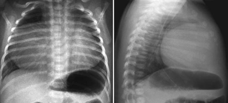 Ebstein’s Malformation and Other Forms of Congenital Tricuspid ...