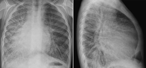 Partial and Total Anomalous Pulmonary Venous Connections | Radiology Key