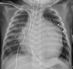 Abnormalities of the Mitral Valve and Related Anomalies | Radiology Key