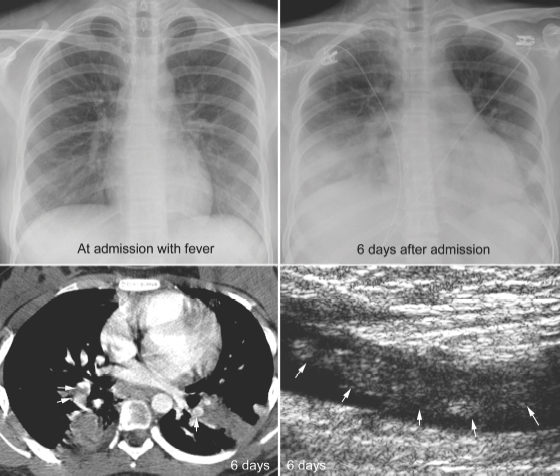 Pulmonary Thromboembolism | Radiology Key