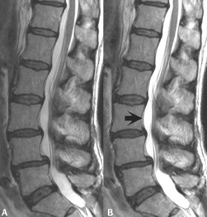 Driven-Equilibrium Fourier Transformation (DEFT) | Radiology Key