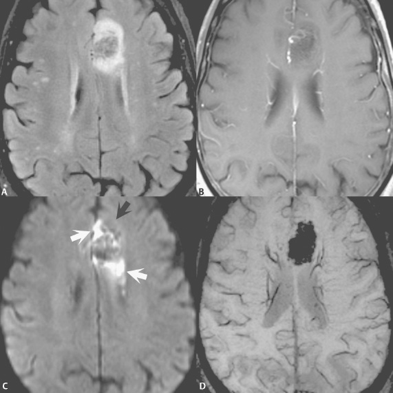 mri-blog-susceptibility-weighted-imaging-ii-ii-image-gallery