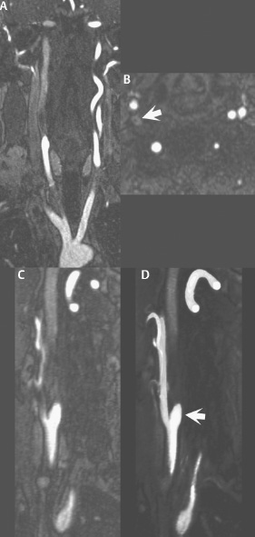 Contrast-Enhanced MRA: Basics; Renal, Abdomen | Radiology Key