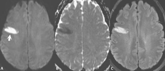 Diffusion Weighted Imaging Radiology Key