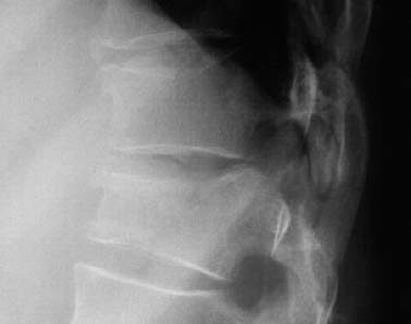 t12 compression fracture