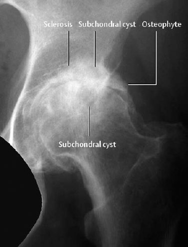 Subchondral sclerosis