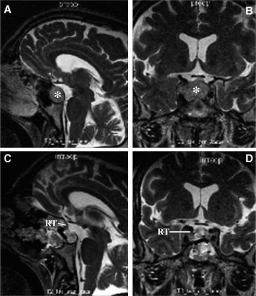 Pituitary Tumor Resection-iMRI In Transsphenoidal Surgery | Radiology Key