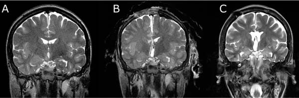 Diffusion Tensor Imaging Guided Resection Radiology Key