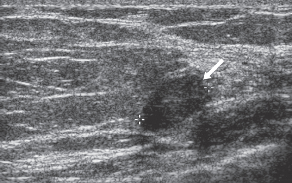 Focal Asymmetry | Radiology Key