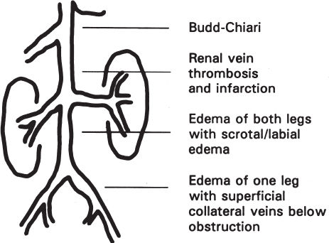 inferior vena cava syndrome