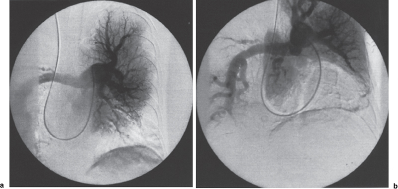 Pulmonary Embolism Diagnosis And Interventional Options For Treatment Radiology Key