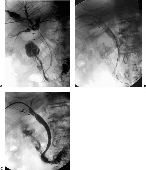 63 Nephrostomy Catheter Placement Radiology Key