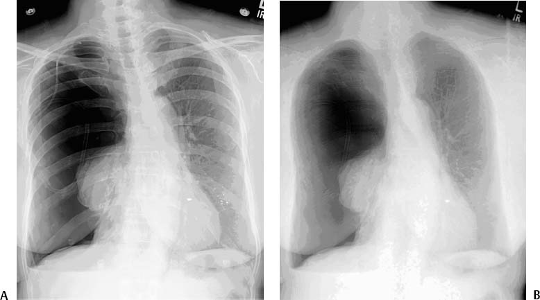 pneumothorax chest tube