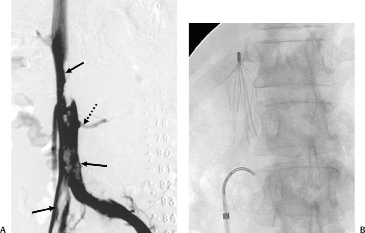 inferior vena cava pregnancy