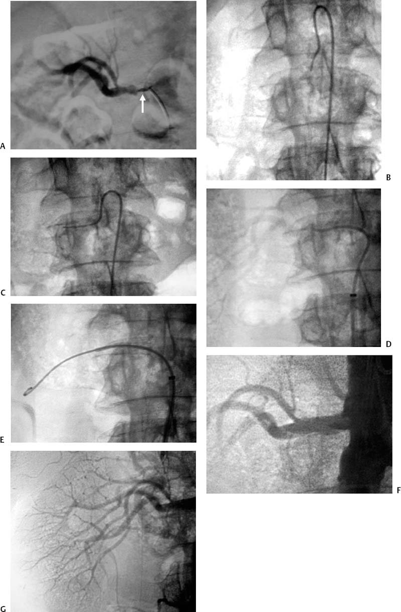 Renal Artery Stenosis Workup