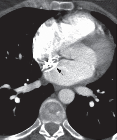 14 Atrial Septal Defect | Radiology Key