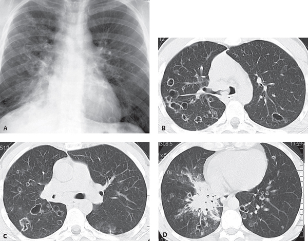 respiratory papillomatosis ct