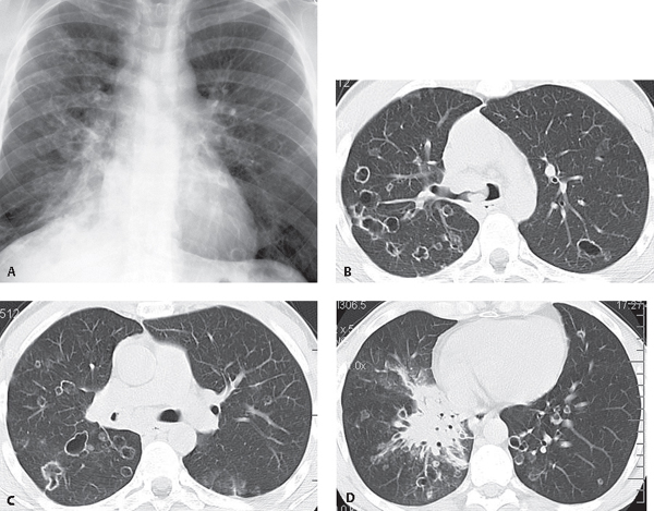 Gége tracheobronchialis papillomatosis - Rákmegelőző állapotok és jóindulatú tumorok