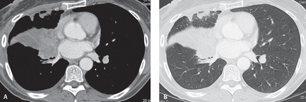 33 Resorption Atelectasis | Radiology Key