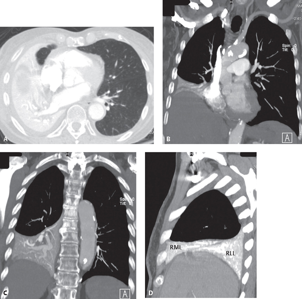 Right Middle Lobe Atelectasis X Ray