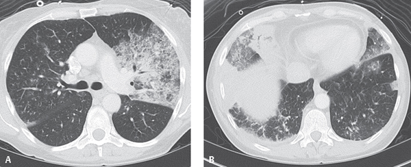 49 Pneumococcal Pneumonia | Radiology Key