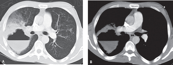 50 Staphylococcus Pneumonia | Radiology Key