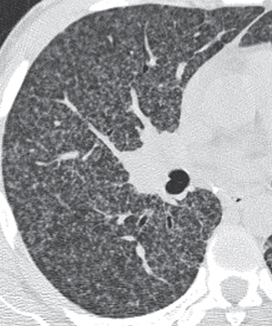 61 Histoplasmosis | Radiology Key