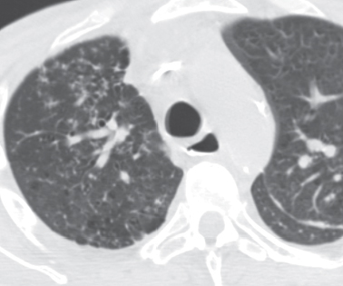 62 Pulmonary Coccidioidomycosis 