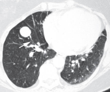 carcinoid bronchial adenoma of right lung icd 10