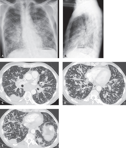 nivolumab and ipilimumab for mesothelioma