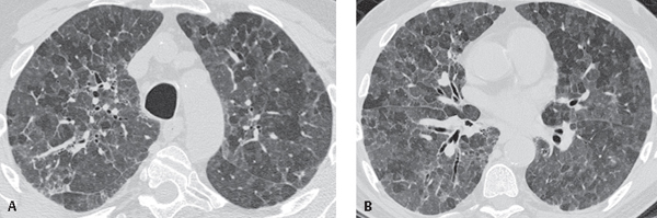 126 Farmer s Lung Radiology Key