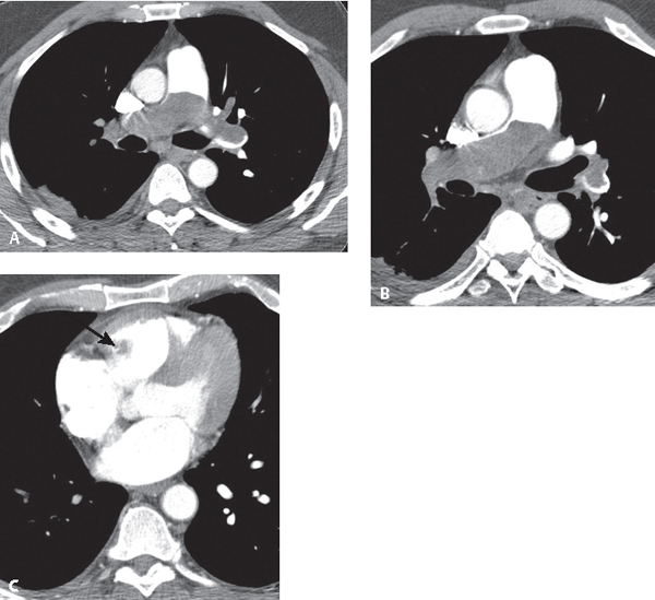 129 Chronic Pulmonary Thromboembolic Disease | Radiology Key