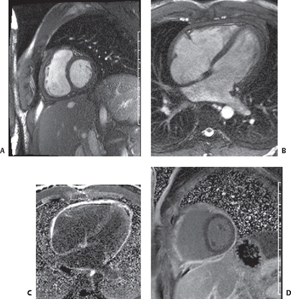 141 Pericardial Calcification Radiology Key