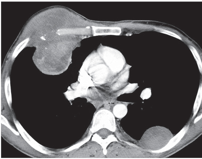 182 Chondrosarcoma | Radiology Key