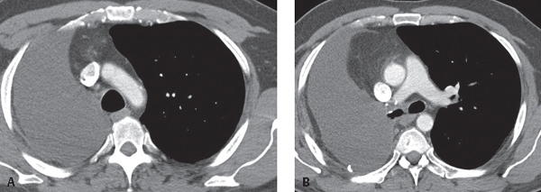 187 Pneumonectomy | Radiology Key