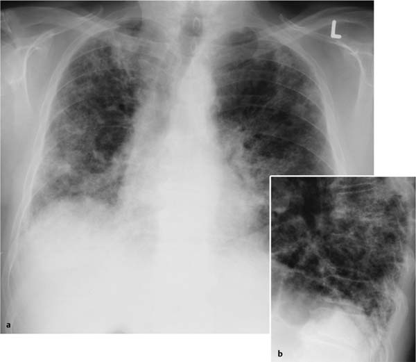 Chest X Ray Fibrosis at Thomas Kidwell blog