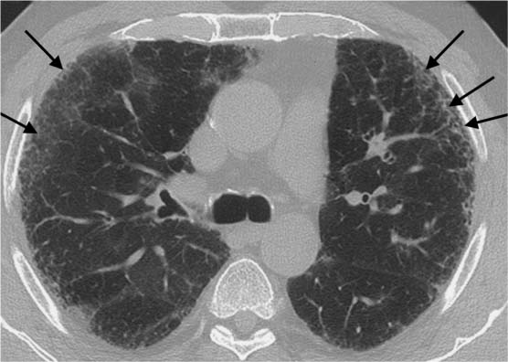 Fibrosing Lung Disease | Radiology Key diagram of the lungs with ipf 