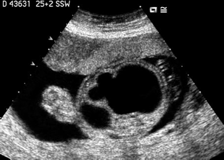 bladder exstrophy ultrasound