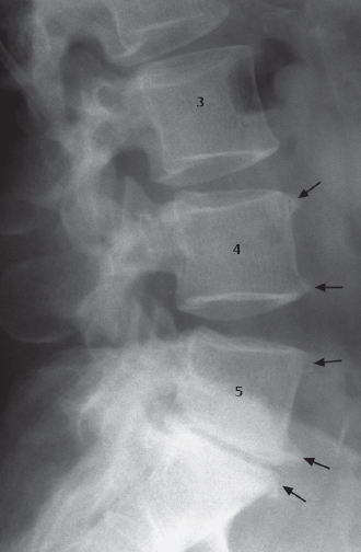 Retrolisthesis Of L3 On L4 Zbuild Web Fc2 Com   9783131606815 C001 F003 