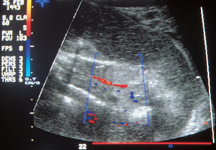 doppler ultrasound pregnancy