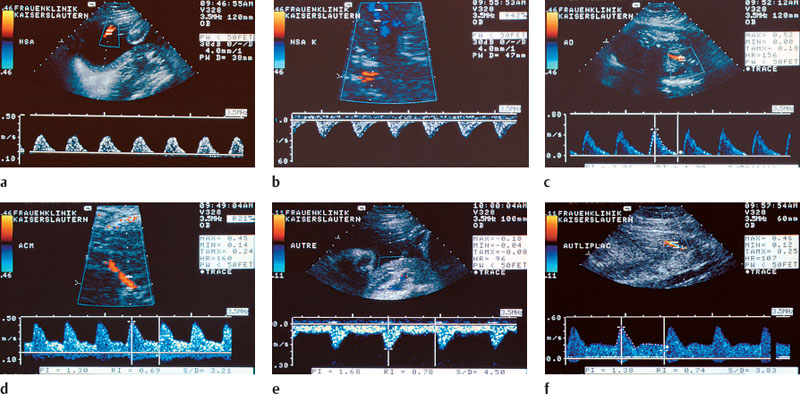 doppler ultrasound pregnancy for nclex