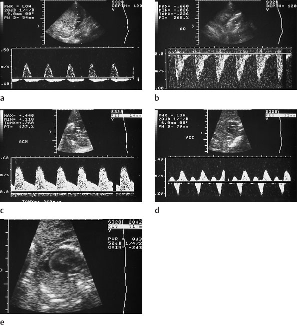 Seven Cases Illustrating the Use of Doppler Ultrasound in Obstetrics ...