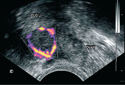 doppler ultrasound pregnancy