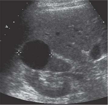 kidney cyst ultrasound and biopsy procedure