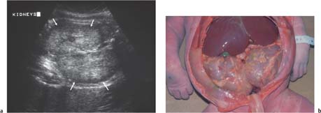 Rafflesia Arnoldi onderschrift barricade Focal Lesions of the Kidney | Radiology Key